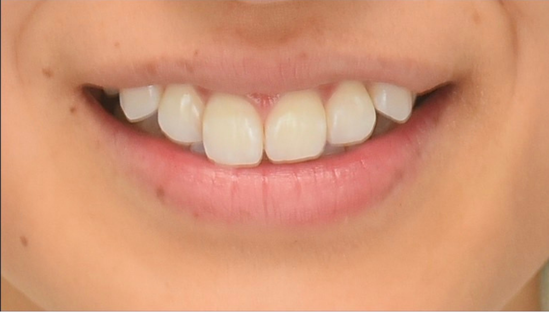 症例01 ホワイトニング後
