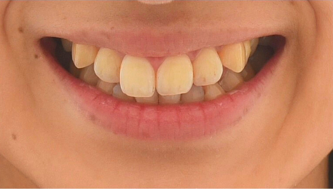 症例01 ホワイトニング前