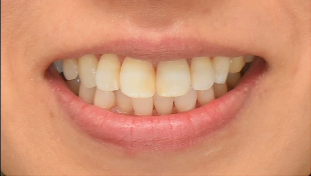 症例02 ホワイトニング後