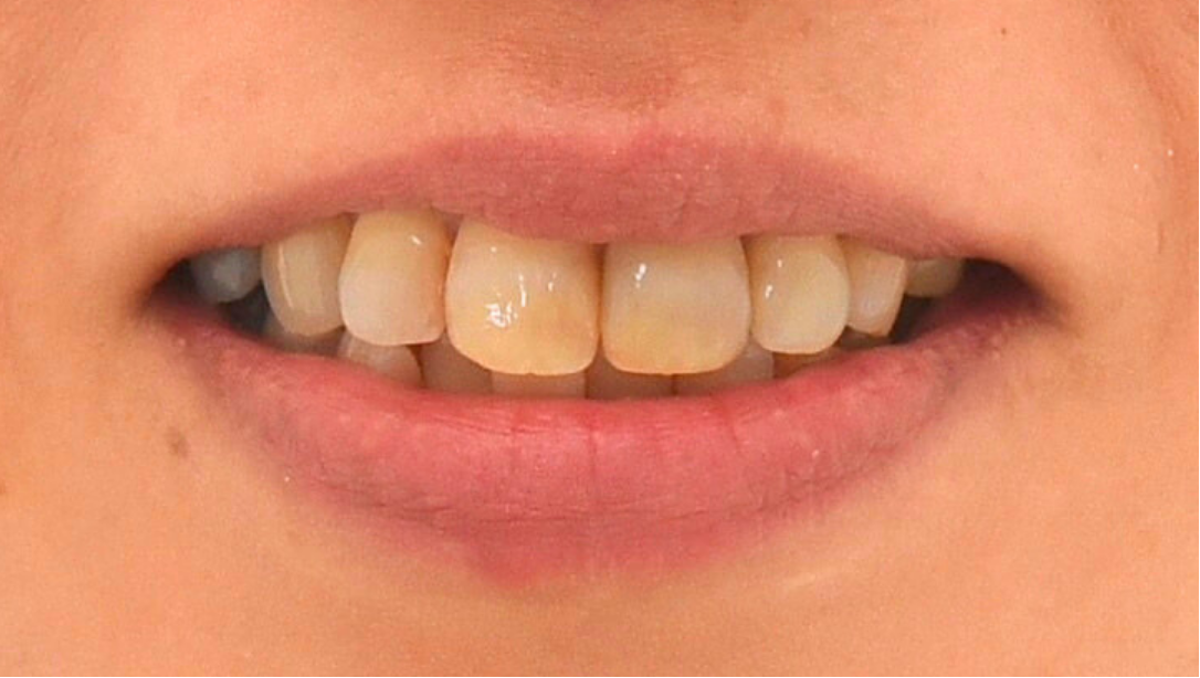 症例02 ホワイトニング前