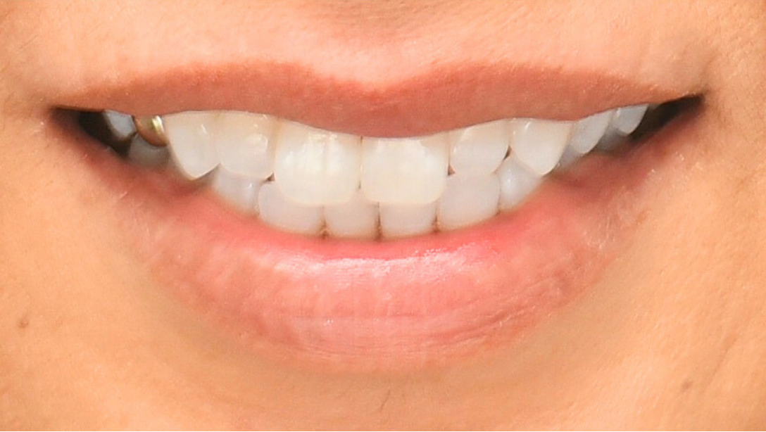 症例03 ホワイトニング後