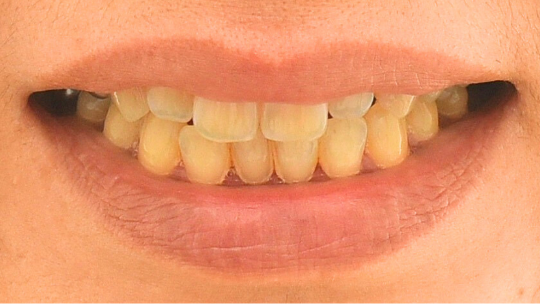 症例03 ホワイトニング前