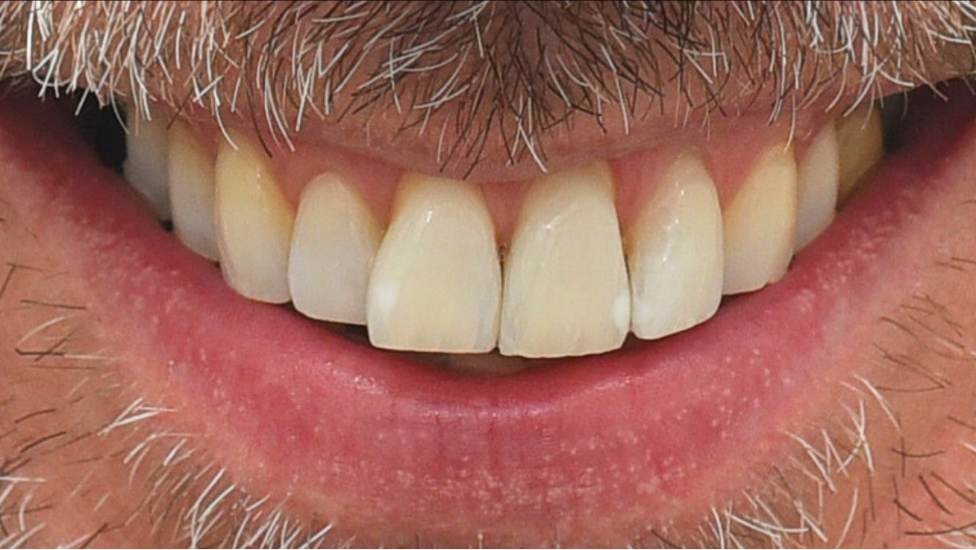 症例04 ホワイトニング後