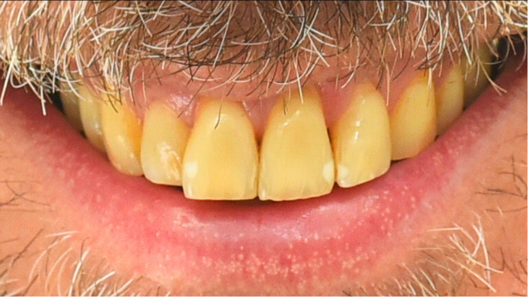 症例04 ホワイトニング前